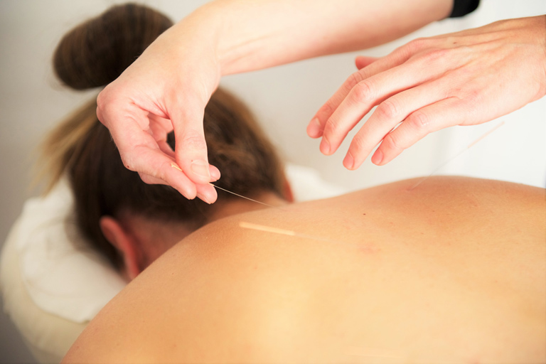 acupuncture